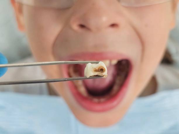 Best Emergency Treatment for Toothache in Deland Southwest, FL